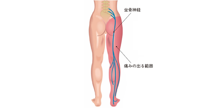 坐骨神経痛